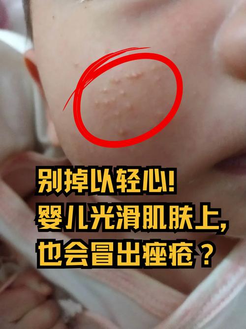 孕期挤痘痘会影响胎宝宝吗？-第1张图片-中州医学会