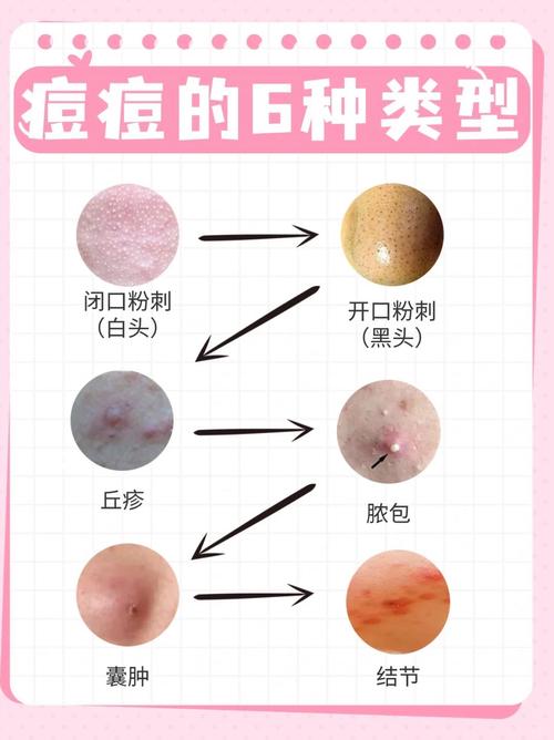 孕期挤痘痘会影响胎宝宝吗？-第3张图片-中州医学会