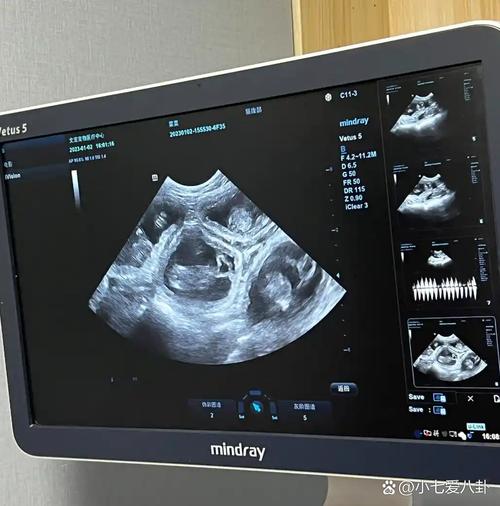 孕期玩手机会导致胎儿畸形吗？-第3张图片-中州医学会