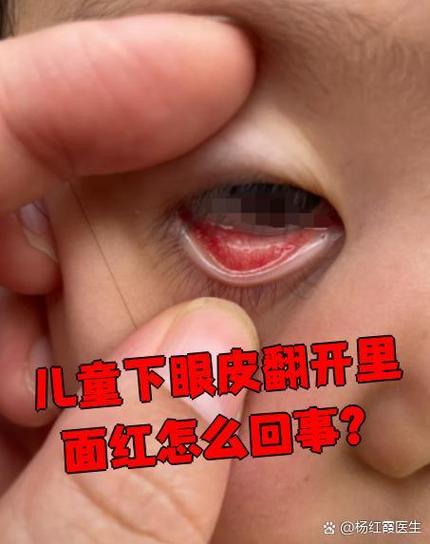 新生儿眼睛红血丝是何原因？-第2张图片-中州医学会