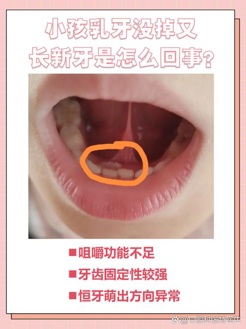 儿童恒牙长出乳牙未脱落怎么办?-第1张图片-中州医学会 儿童恒牙长出乳牙未脱落怎么办?-第1张图片-中州医学会