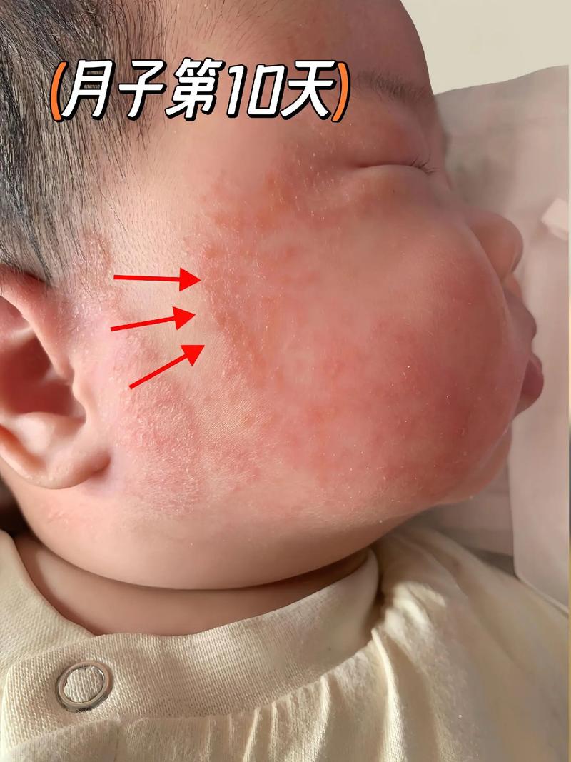 新生儿脸上红血丝会自行消退吗？-第1张图片-中州医学会