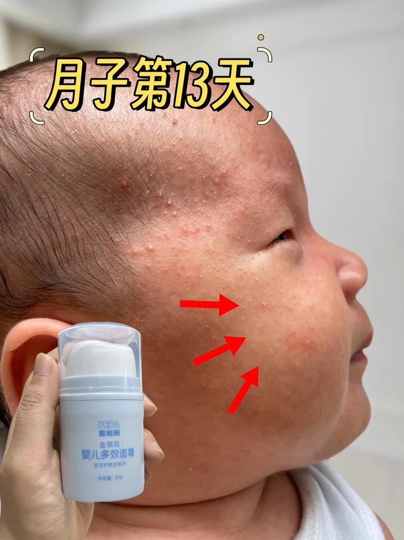 新生儿脸上红血丝会自行消退吗？-第3张图片-中州医学会