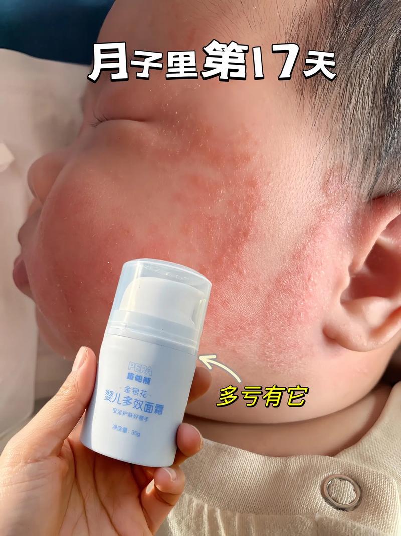 新生儿脸上红血丝会自行消退吗？-第2张图片-中州医学会