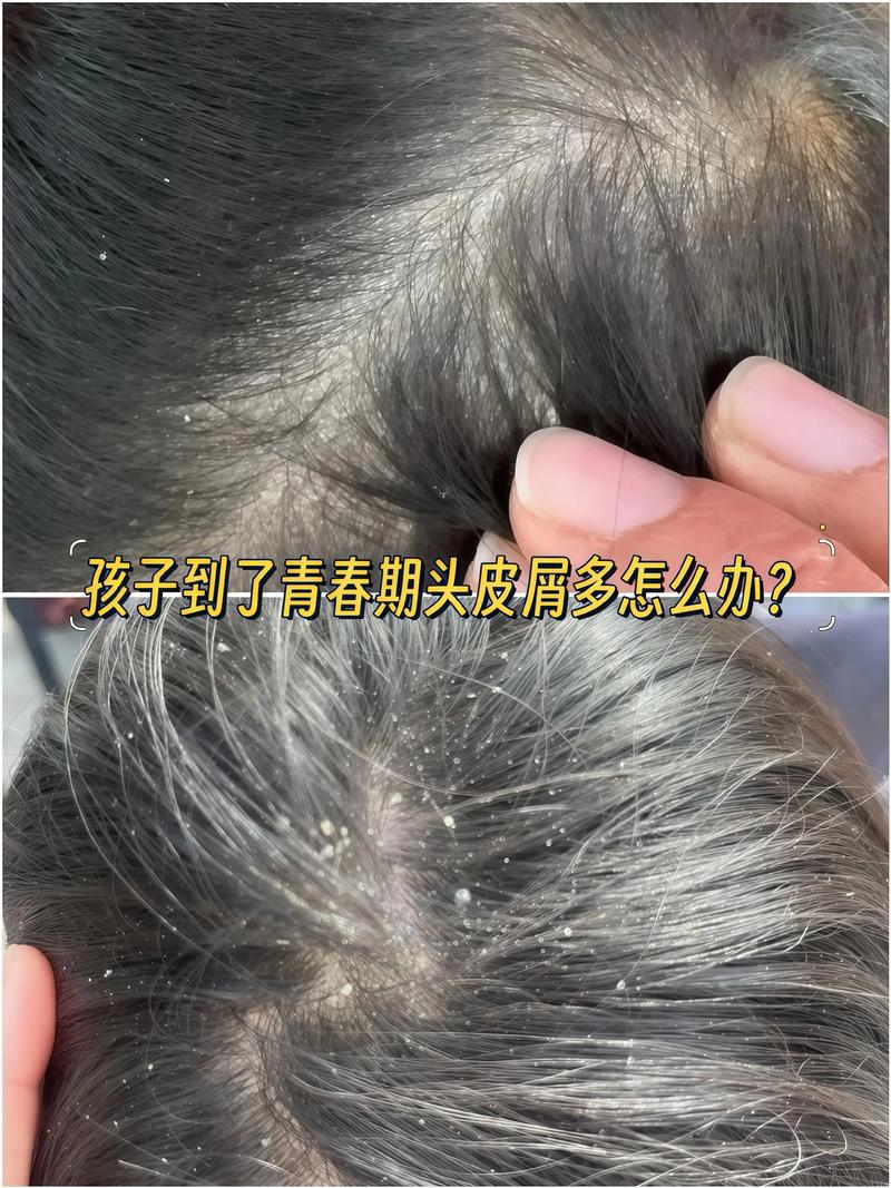 儿童头上有头皮屑,是啥原因引起的?-第3张图片-中州医学会 儿童头上有头皮屑,是啥原因引起的?-第3张图片-中州医学会