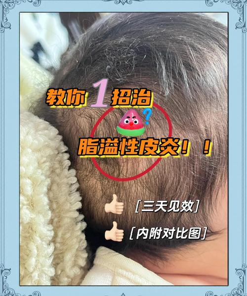 儿童头上有头皮屑,是啥原因引起的?-第2张图片-中州医学会 儿童头上有头皮屑,是啥原因引起的?-第2张图片-中州医学会