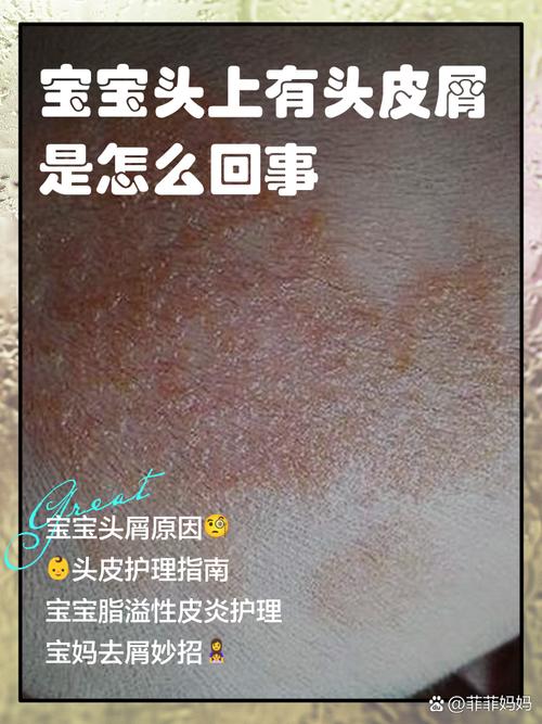 儿童头上有头皮屑,是啥原因引起的?-第1张图片-中州医学会 儿童头上有头皮屑,是啥原因引起的?-第1张图片-中州医学会