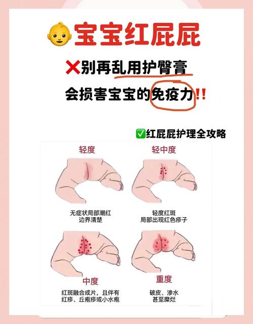 新生儿屁屁发红有红点咋办?-第1张图片-中州医学会 新生儿屁屁发红有红点咋办?-第1张图片-中州医学会