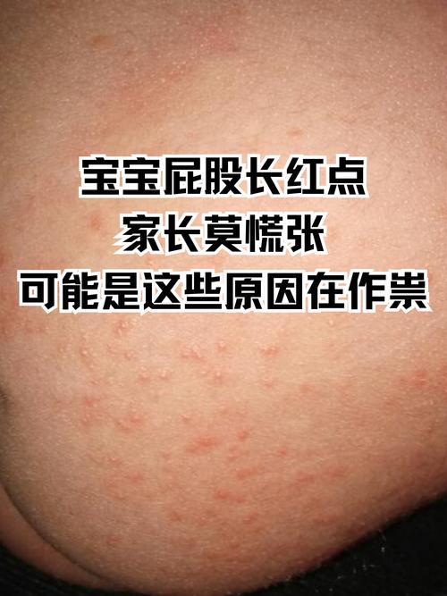 新生儿屁屁发红有红点咋办?-第3张图片-中州医学会 新生儿屁屁发红有红点咋办?-第3张图片-中州医学会