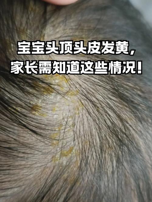 新生儿头顶头发稀少是何原因？-第3张图片-中州医学会