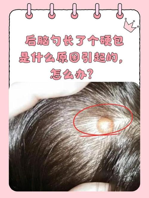 新生儿头上软包多久能自行吸收？-第3张图片-中州医学会