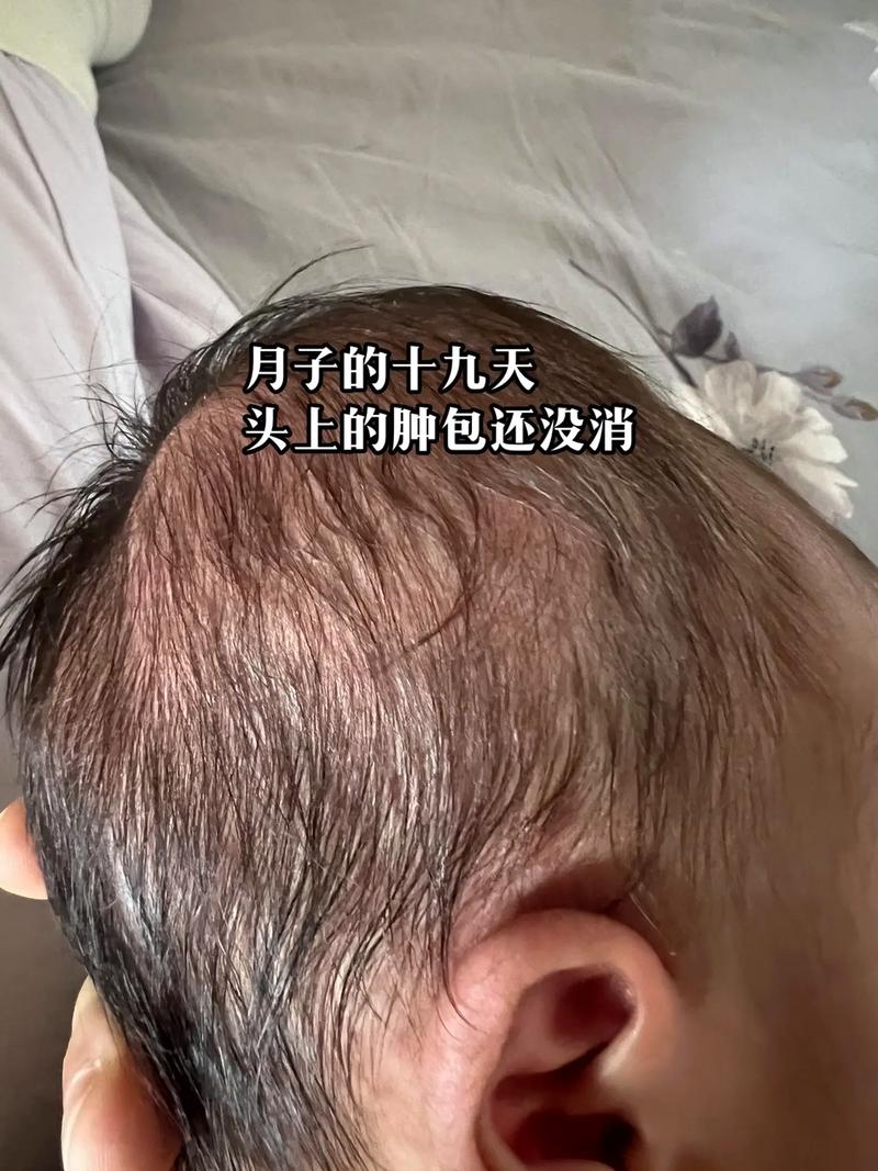 新生儿头上软包多久能自行吸收？-第2张图片-中州医学会