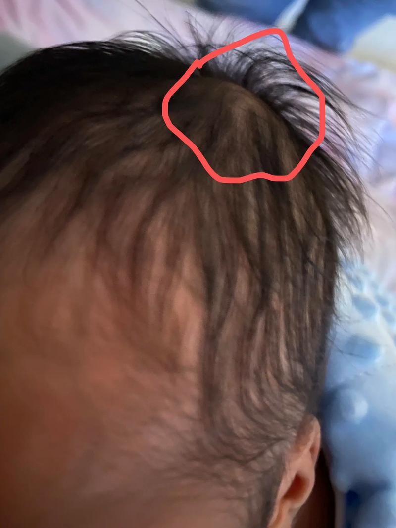 新生儿头上软包多久能自行吸收？-第1张图片-中州医学会