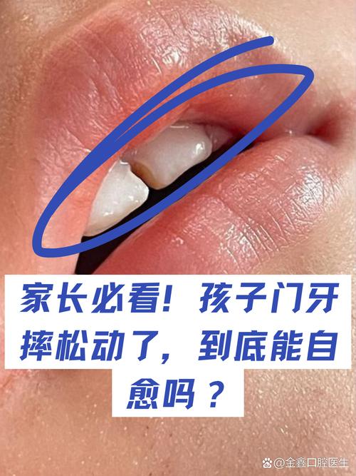 儿童门牙松动一直不掉怎么办?-第1张图片-中州医学会 儿童门牙松动一直不掉怎么办?-第1张图片-中州医学会