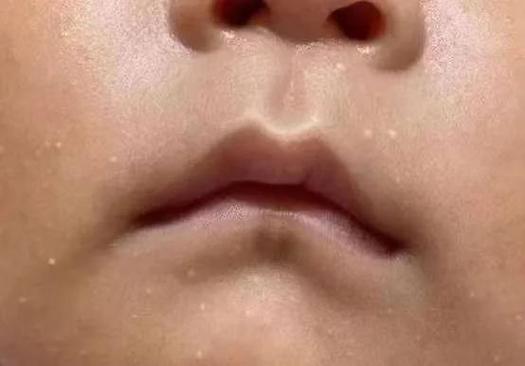 新生儿鼻头小白点是何原因？-第3张图片-中州医学会