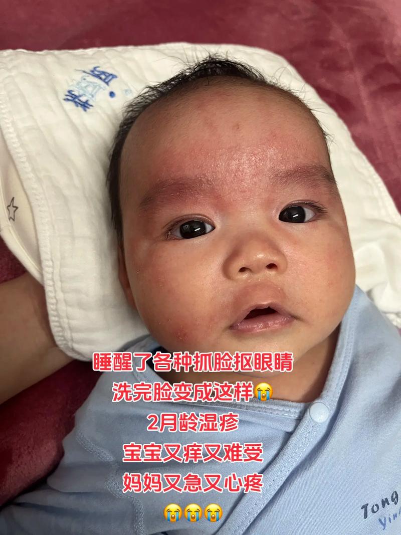 新生儿湿疹多久能自行消失？-第1张图片-中州医学会