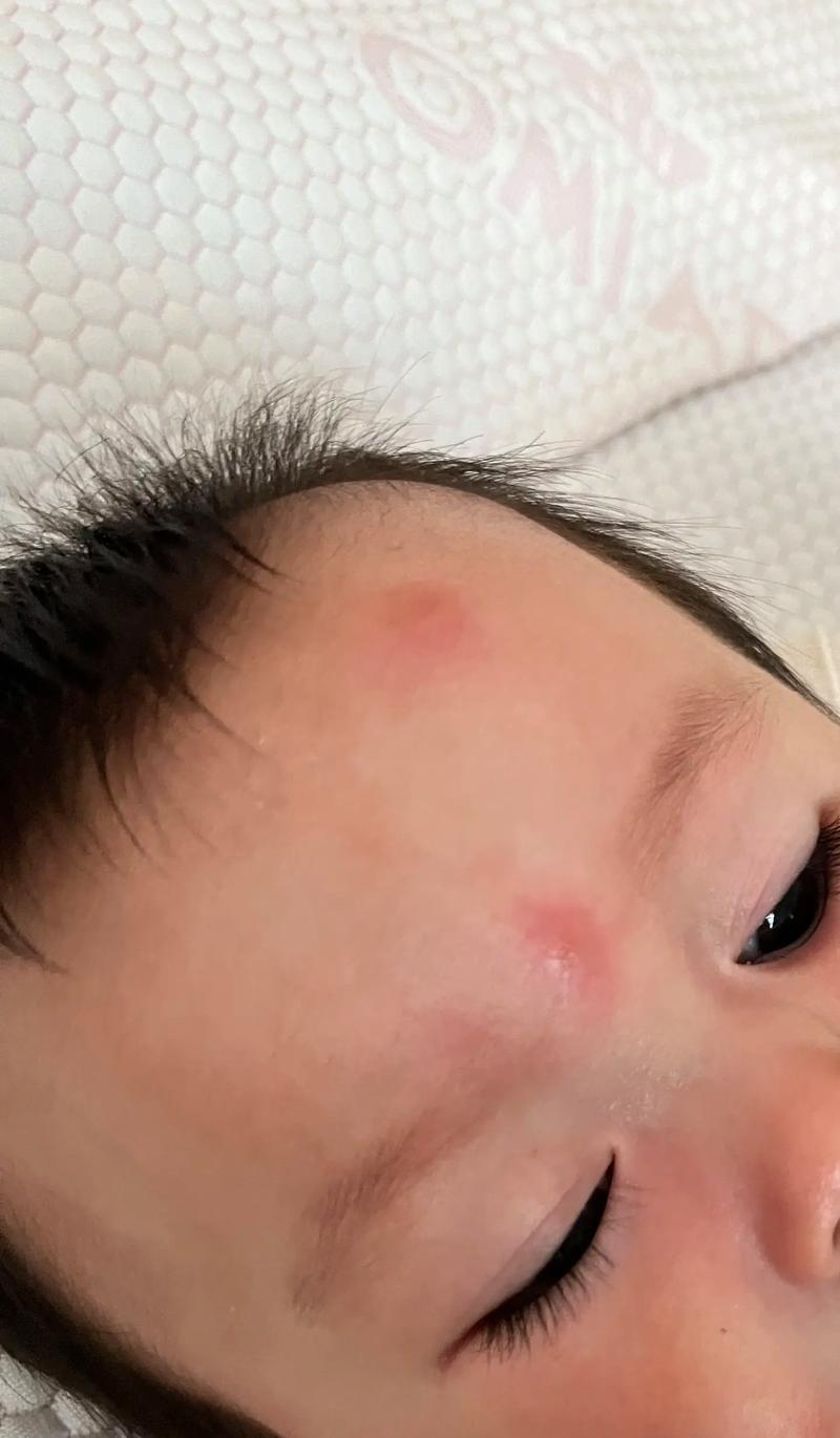 新生儿被蚊子咬起红点咋处理？-第1张图片-中州医学会