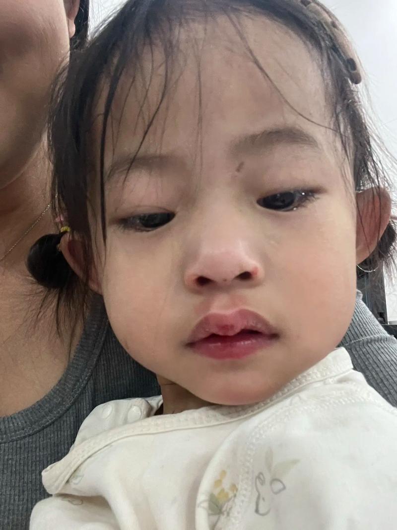 3岁乳门牙磕断，紧急处理要这样做吗？-第1张图片-中州医学会