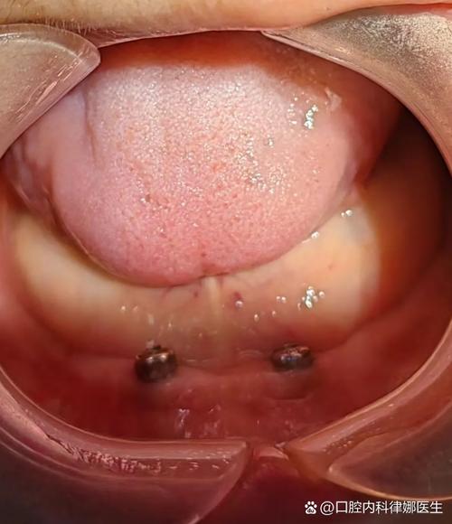 3岁乳门牙磕断，紧急处理要这样做吗？-第3张图片-中州医学会