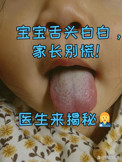 新生儿舌苔厚白是何原因？-第2张图片-中州医学会