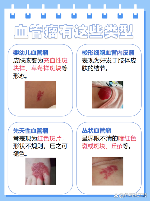 新生儿血管瘤最佳治疗时机是何时？-第2张图片-中州医学会