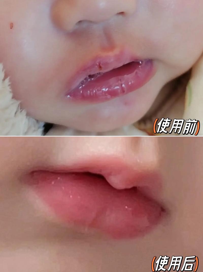 新生儿下嘴唇老颤抖是怎么回事-第3张图片-中州医学会