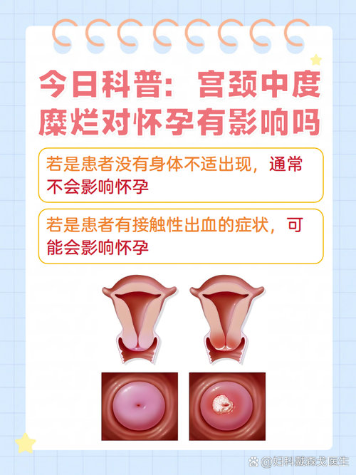 孕期宫颈糜烂需治疗吗?-第1张图片-中州医学会 孕期宫颈糜烂需治疗吗?-第1张图片-中州医学会