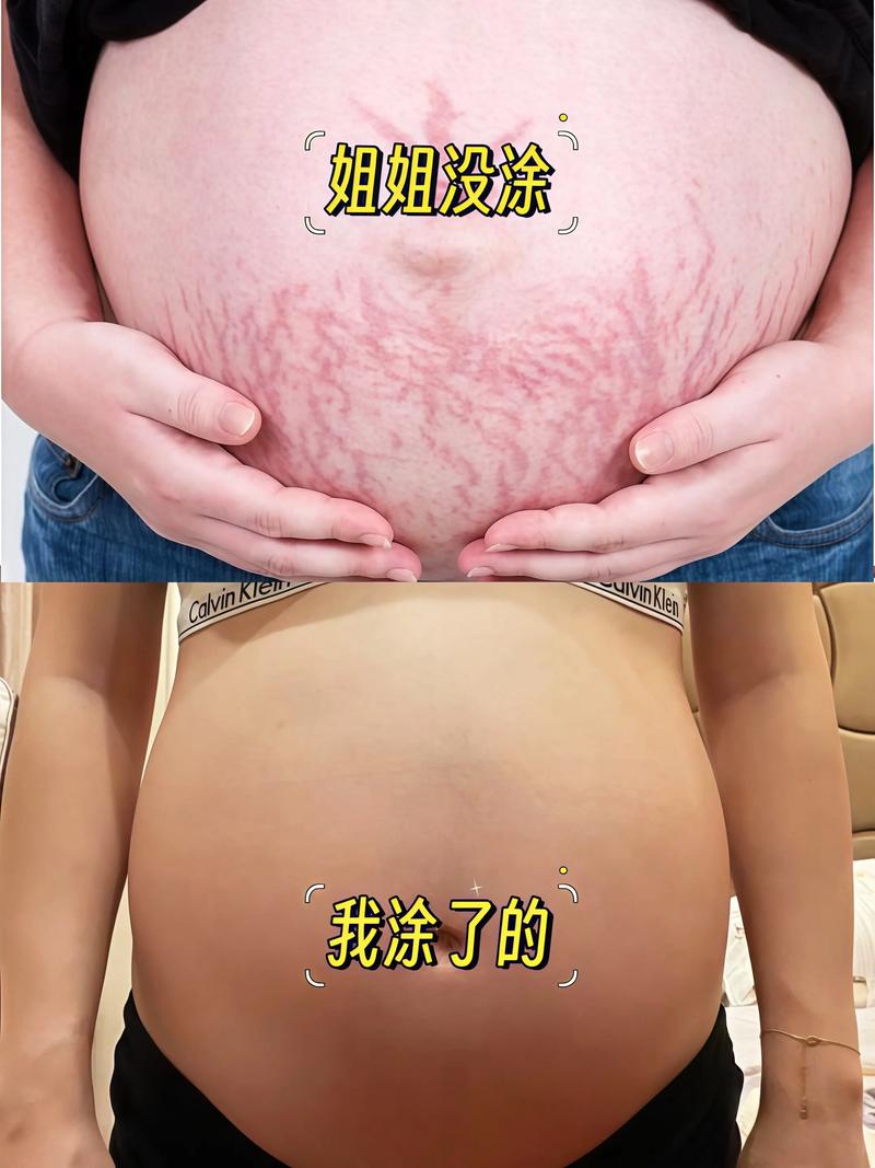 孕期几时开始长妊娠纹?-第1张图片-中州医学会 孕期几时开始长妊娠纹?-第1张图片-中州医学会