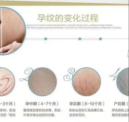 孕期几时开始长妊娠纹?-第2张图片-中州医学会 孕期几时开始长妊娠纹?-第2张图片-中州医学会
