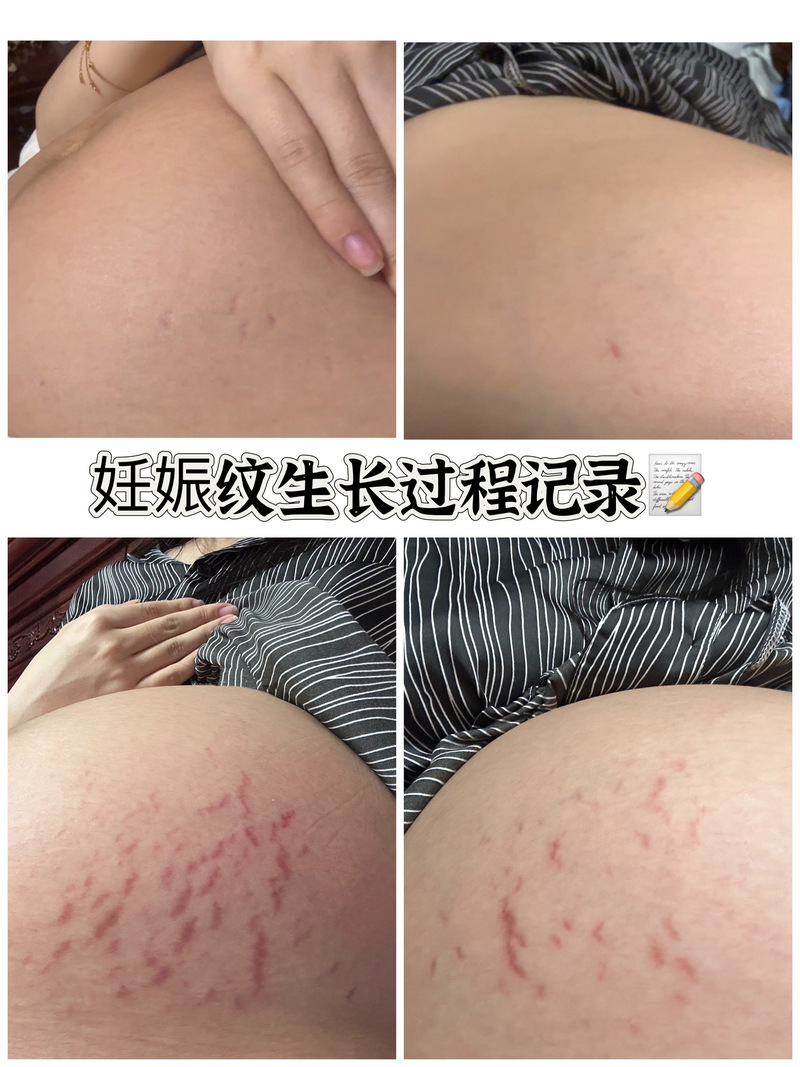 孕期几时开始长妊娠纹?-第3张图片-中州医学会 孕期几时开始长妊娠纹?-第3张图片-中州医学会
