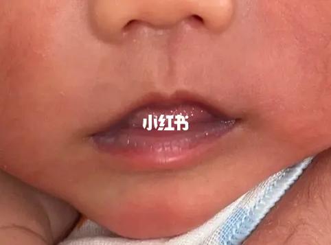 新生儿嘴发紫是缺氧吗？-第3张图片-中州医学会