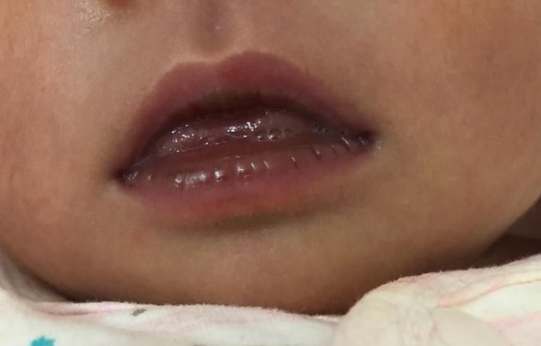 新生儿嘴发紫是缺氧吗？-第1张图片-中州医学会