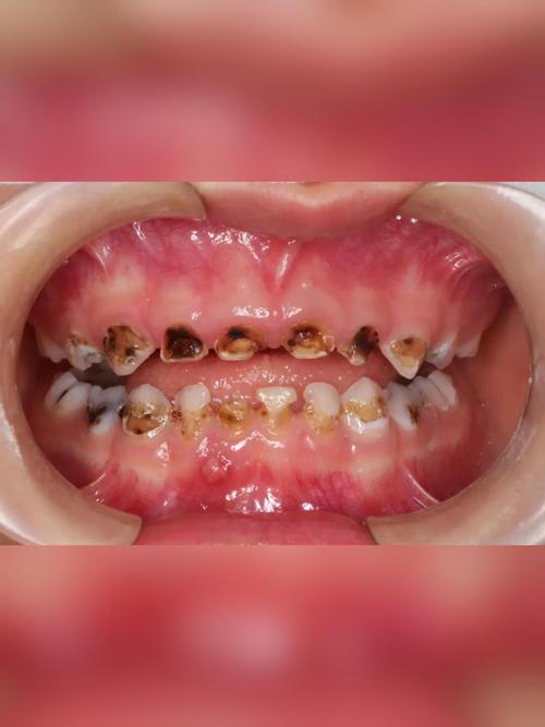 儿童乳牙有蛀洞，到底该不该治？-第2张图片-中州医学会
