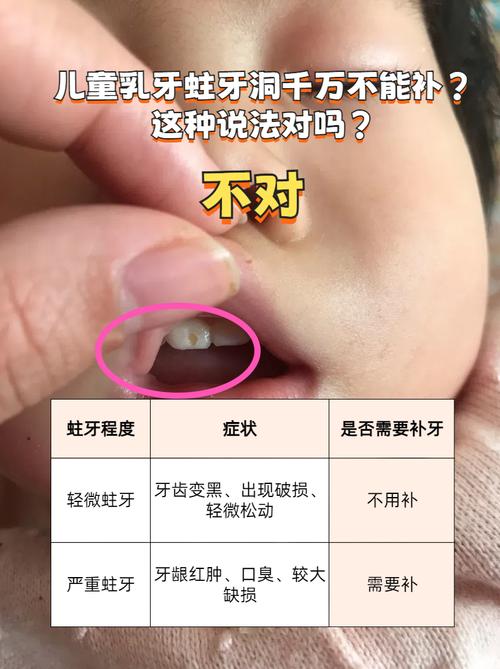 儿童乳牙有蛀洞，到底该不该治？-第1张图片-中州医学会