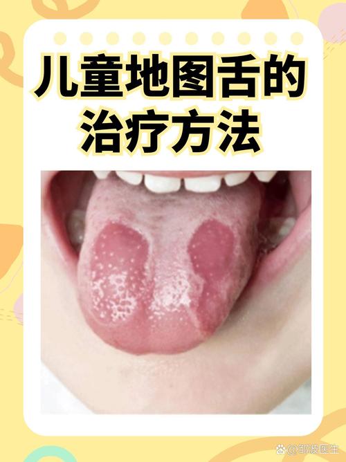 儿童地图舌是何原因引起？-第1张图片-中州医学会