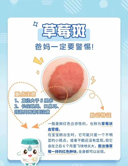 新生儿长胎记是何原因造成？-第2张图片-中州医学会