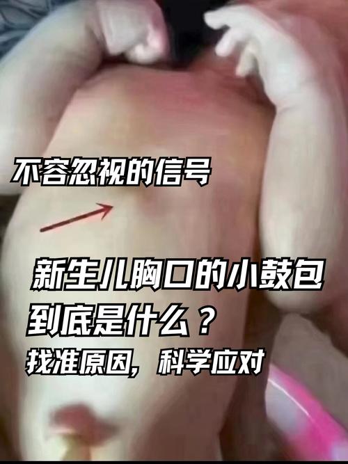 新生儿肺部纹理增多是什么意思-第3张图片-中州医学会