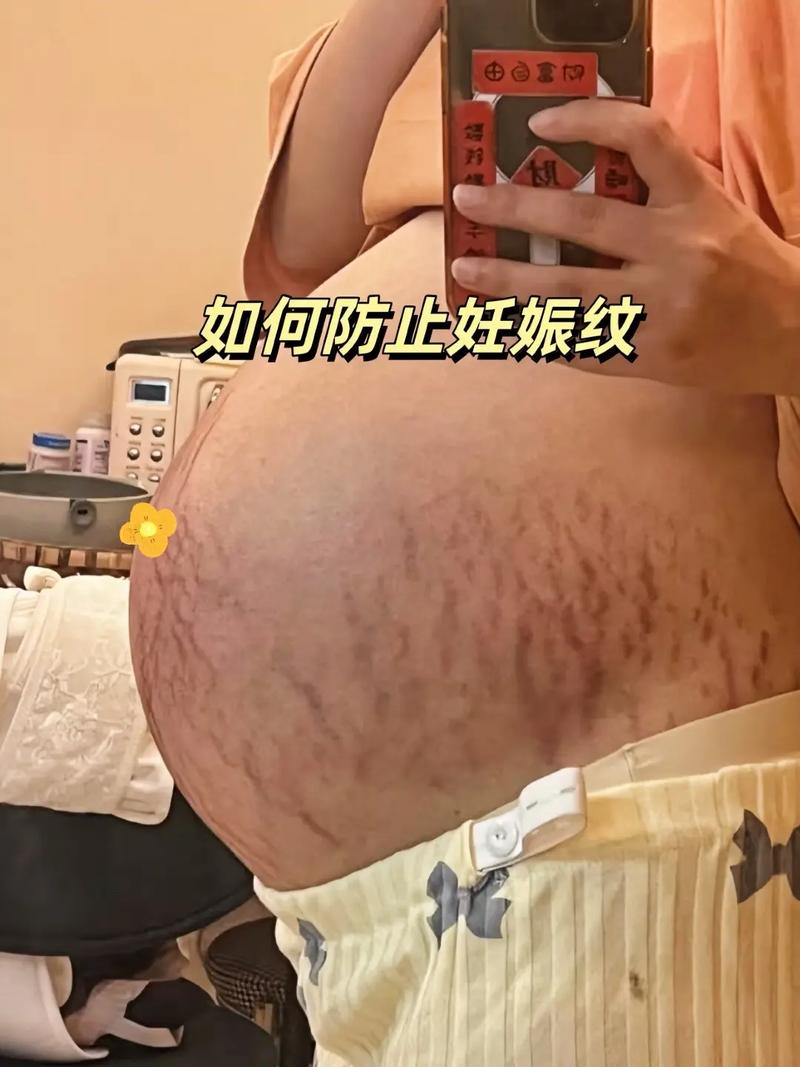 孕期肚子上长妊娠纹怎么办？-第3张图片-中州医学会
