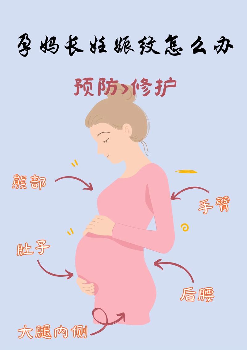 孕期肚子上长妊娠纹怎么办？-第2张图片-中州医学会