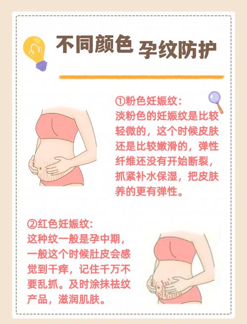 孕期肚子上长妊娠纹怎么办？-第1张图片-中州医学会