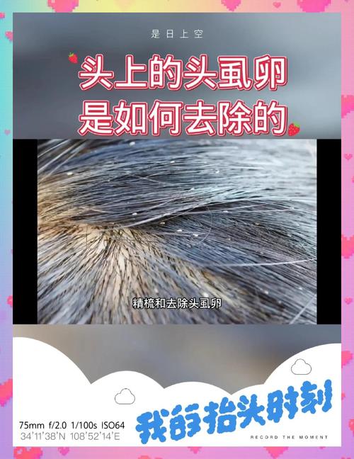 怀孕期间头上长虱子怎么办-第1张图片-中州医学会