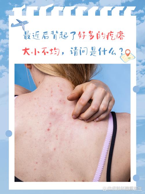 孕期后背长痘是激素变化还是其他原因？-第3张图片-中州医学会