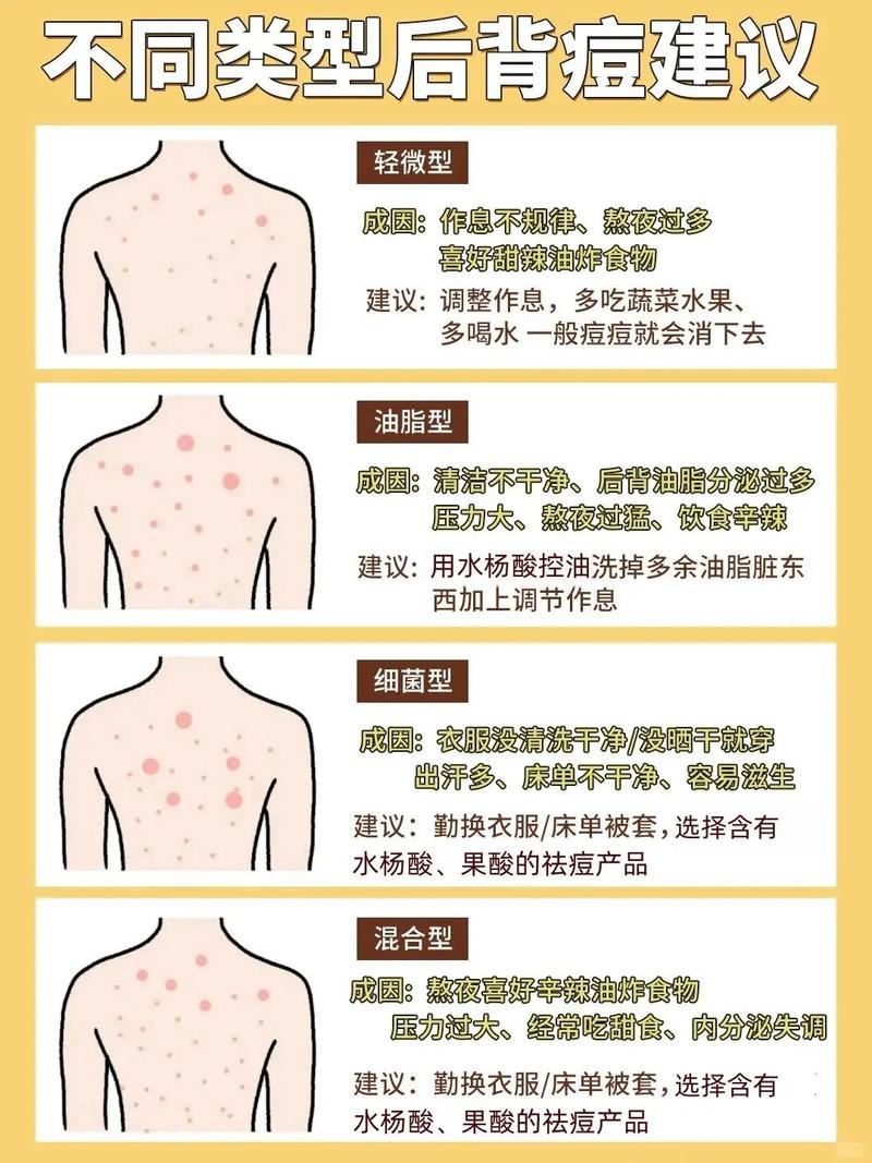 孕期后背长痘是激素变化还是其他原因？-第2张图片-中州医学会