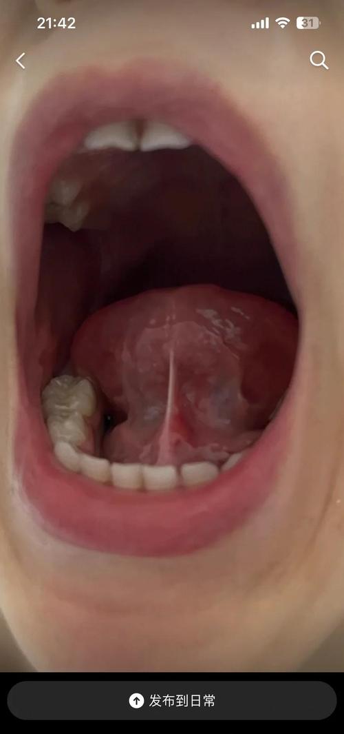 儿童舌系带短手术费用是多少？-第1张图片-中州医学会