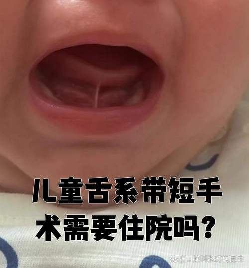 儿童舌系带短手术费用是多少？-第2张图片-中州医学会