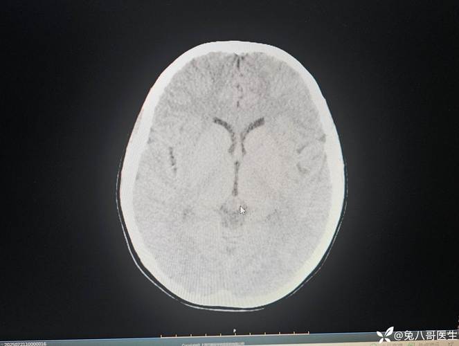 儿童松果体肿瘤治愈能活多久-第1张图片-中州医学会