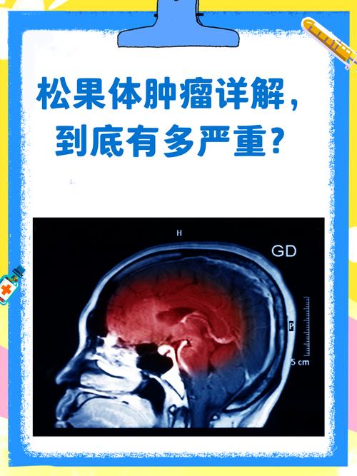 儿童松果体肿瘤治愈能活多久-第3张图片-中州医学会