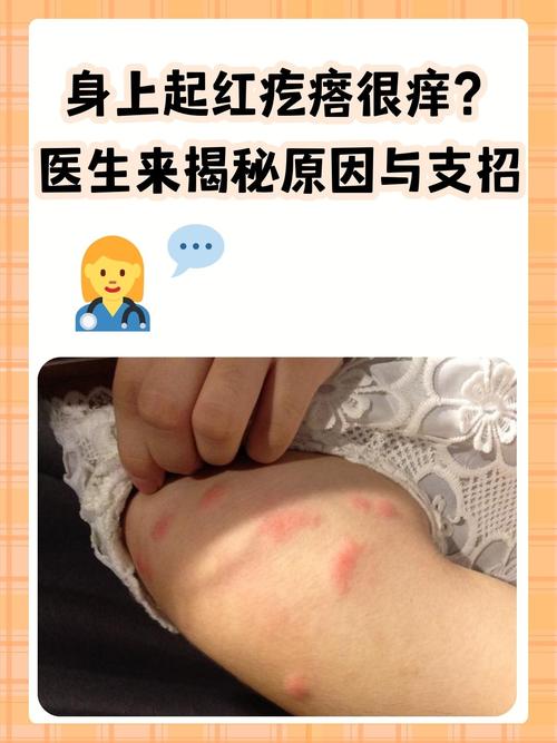 孕期长痒疙瘩怎么办?-第1张图片-中州医学会 孕期长痒疙瘩怎么办?-第1张图片-中州医学会