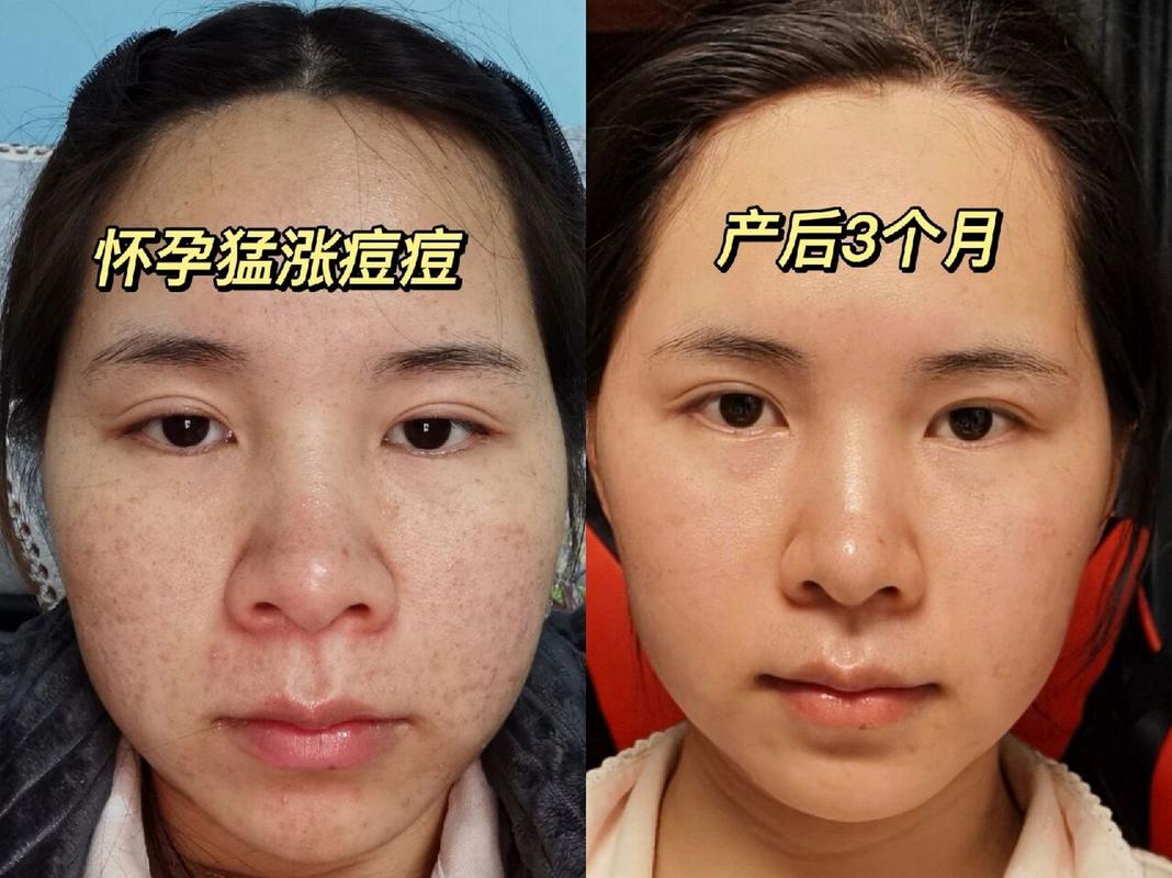 孕期满脸痘痘是激素变化还是皮肤问题？-第3张图片-中州医学会