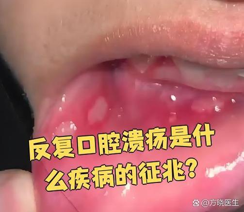儿童反复口腔溃疡警惕哪五种病?-第3张图片-中州医学会 儿童反复口腔溃疡警惕哪五种病?-第3张图片-中州医学会